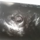 echo2 9weken en 4dagen Mijn kleine "cashewnootje" beweegt al