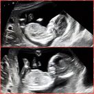 Jongen of meisje? Echo gemaakt bij 15 weken zwanger. Is hier überhaupt geslacht zichtbaar?