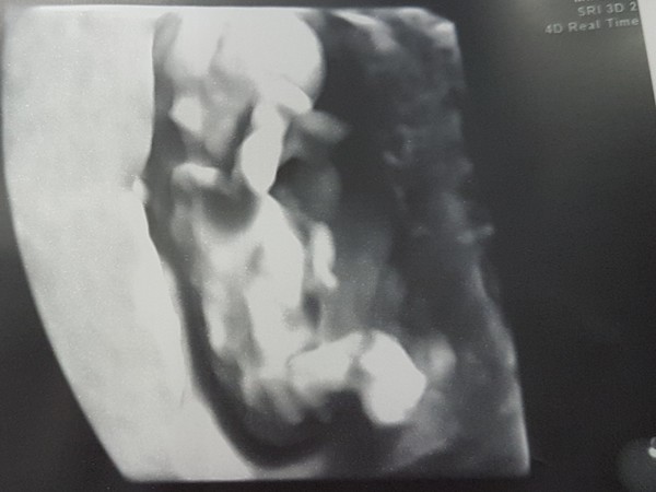 Babygirl 12+3 4D echo kleine prinses