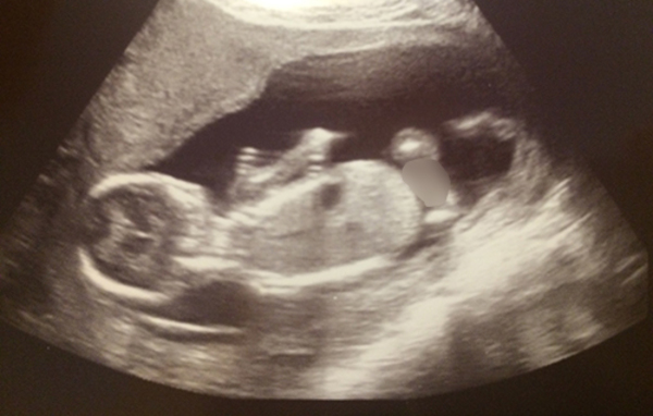 Echo bij 15w3d We hebben een echo gekregen tijdens de intake bij de verloskundige <3 Druk aan het bewegen, maar zij/hij bleef weggedraaid.
Aangezien we niet willen weten wat het wordt, en sommige meiden hier daar nogal een scherp oog voor hebben die sectie maar even onduidelijk gemaakt ;)