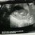 echo 11 week en 1 dag 