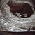 7 weken echo  je kunt de verbinding tussen het dooierzakje rechts en de embryo links goed zien