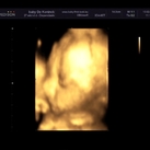  3d echo op 27weken en 4dagen 