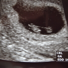 7 weken echo je kunt de verbinding tussen het dooierzakje rechts en de embryo links goed zien