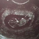 Babytje 11 weken zwanger :) 