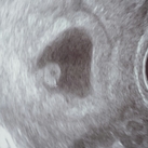 ♡ 6w3d hopelijk blijft alles goed gaan! Kloppend hartje gezien!