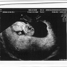 Ons klein garnaaltje de aller eerste echo!!! 10 weken en 4 dagen

Mama en papa verschoten hun een ongeluk toen ze te horen kregen dat ze zwanger waren!!