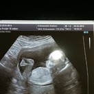 merk Krijt presentatie 7 weken zwanger leeg vruchtzakje 4 weken | Zwangerschapsforum