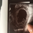  9weken 3 dagen, na lichte bloeding toch hartje te zien❤️