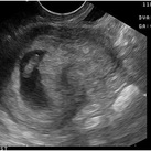 Eerste echo 7w5d 