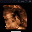 28+4 3D echo 