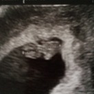 Echo 8 wk 