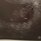 Eerste echo (8w 1d 