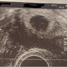 Echo 1: 5/11/2018 6 + 0 weken Na 3,5 jaar wordt ons wachten beloond! Een kloppend hartje gezien, hoe mini het ook was! De embryo zit op de juiste plek en we zien heel duidelijk een dooierzak.. embryo 2.3 mm. 