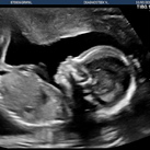 19+2 20wkn echo Alles is goed met ons meisje (L)