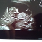 Meisje of jongen? Wie kan zien of dit een meisje of jongen is, 12 weken echo.