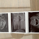Echo met 7 weken en 4 dagen. 